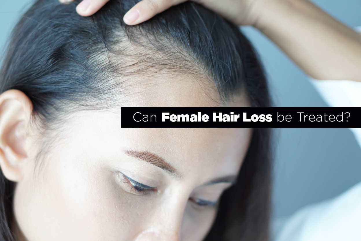 Female Hair Loss