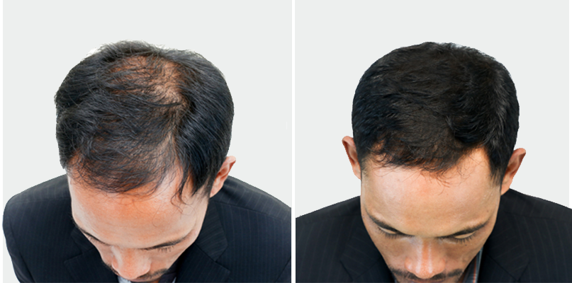 Hair loss Before and after photos