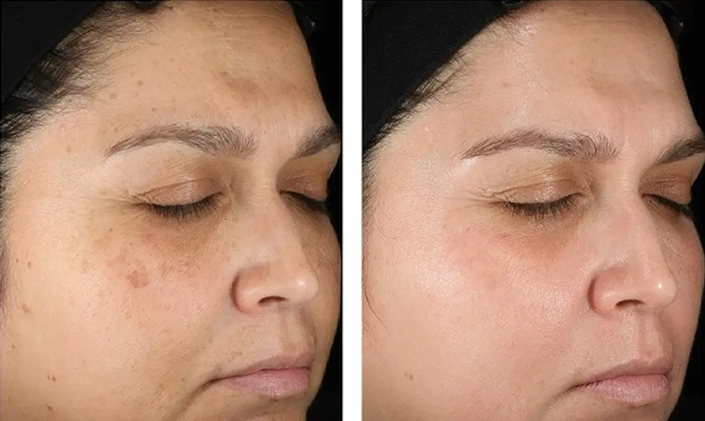 Skin Treatment Before and after photos